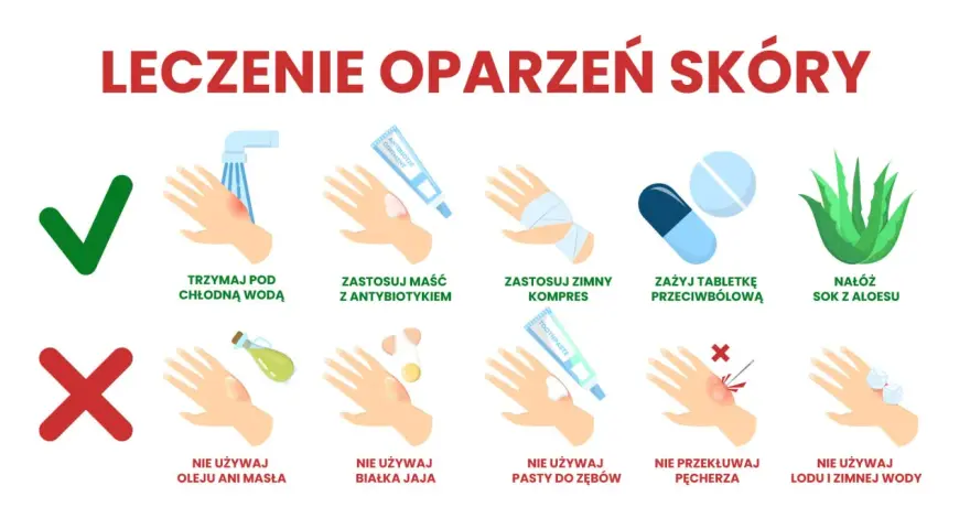 Leczenie oparzeń skóry: chłodna woda, maść z antybiotykiem, zimny kompres, tabletki przeciwbólowe, aloes. Unikaj masła, jajka, pasty do zębów, przekłuwania pęcherzy, lodu. Oparzenie 3 stopnia wymaga ostrożności.