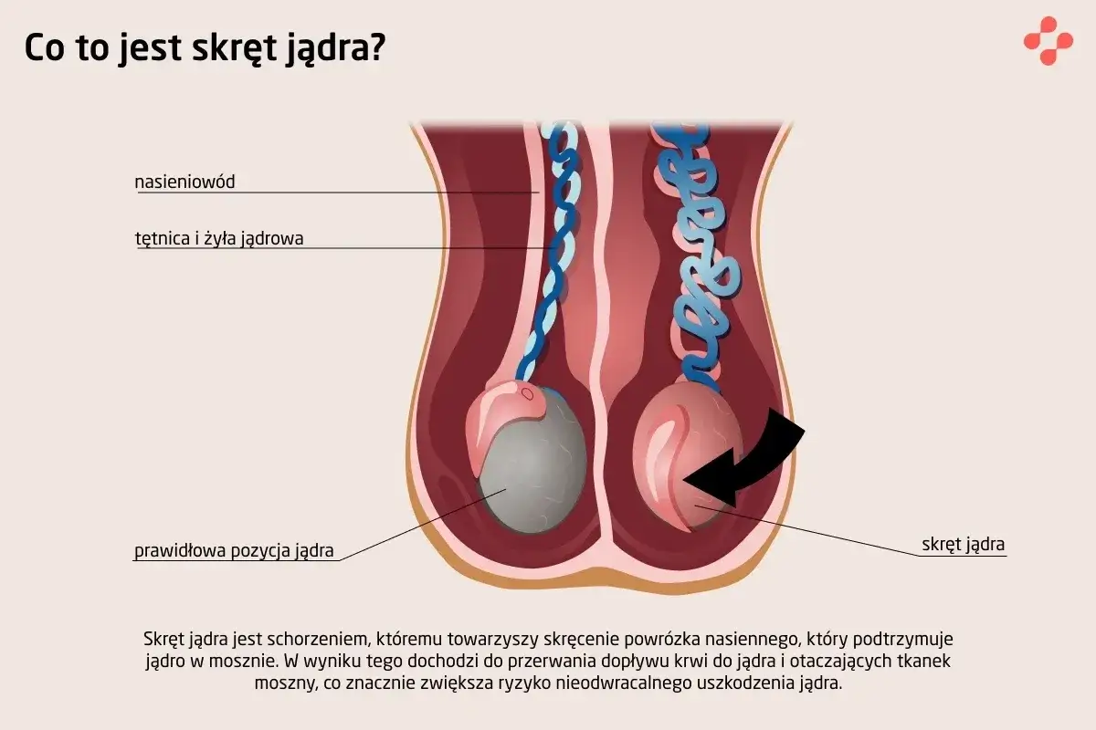 Ilustracja pokazuje skręt jądra, stanowiący przyczynę silnego bólu jądra, gdzie powrózek nasienny się skręca, blokując dopływ krwi.