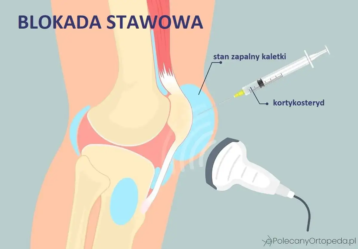 Blokada stawowa: zastrzyk kortykosterydu, np. Diprophos, w stan zapalny kaletki kolana, pod kontrolą USG.