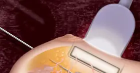 Ilustracja przedstawia biopsję mammotomiczną piersi z użyciem sondy ultradźwiękowej i igły.