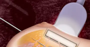 Ilustracja przedstawia biopsję mammotomiczną piersi z użyciem sondy ultradźwiękowej i igły.