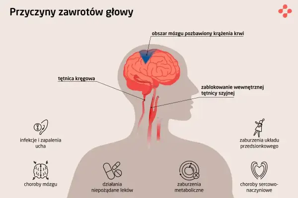 Ilustracja przedstawia przyczyny zawrotów głowy: zablokowanie tętnicy szyjnej, infekcje ucha, choroby mózgu, zaburzenia metaboliczne i sercowo-naczyniowe.