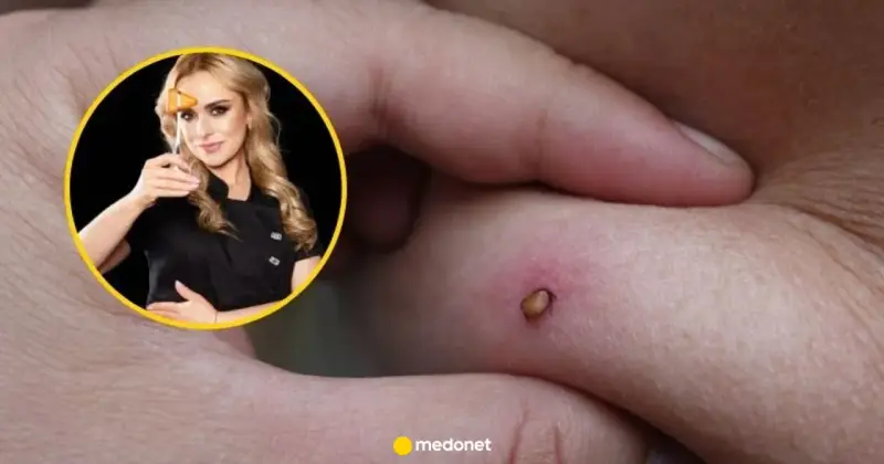 Kobieta z młoteczkiem neurologicznym i rana na skórze, która może być objawem neuroboreliozy.