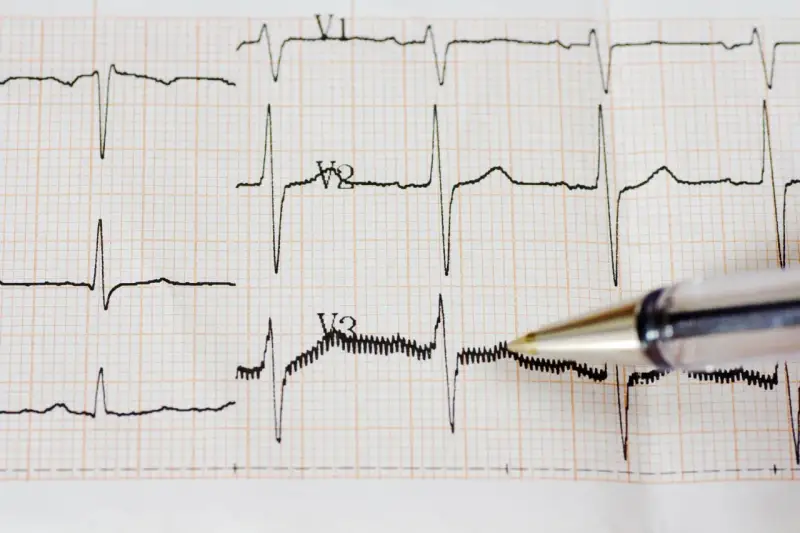 Zapis EKG z widocznym częstoskurczem nadkomorowym. Długopis wskazuje na fragment zapisu.
