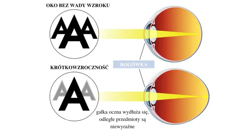 Budowa oka: zdrowe oko skupia światło na siatkówce, oko krótkowzroczne ma wydłużoną gałkę, przez co obraz jest nieostry.